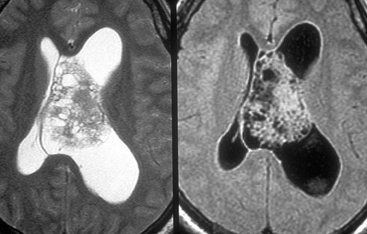 Neurocytoma Image Findings General Features Location Supratentorial, involving lateral and 3 rd ventricles 50% in anterior portion of one of the lateral ventricles Attachment to the septum pellucidum