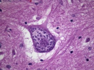 Considerations Most of These Are Either: Tumors that have histologic evidence of neuronal differentiation Exclusively neuronal neoplasms are relatively rare (gangliocytoma, central neurocytoma)