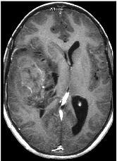 CNS PNET (embryonal tumors) Image Findings General Features Location Most often supratentorial May involve the spinal cord