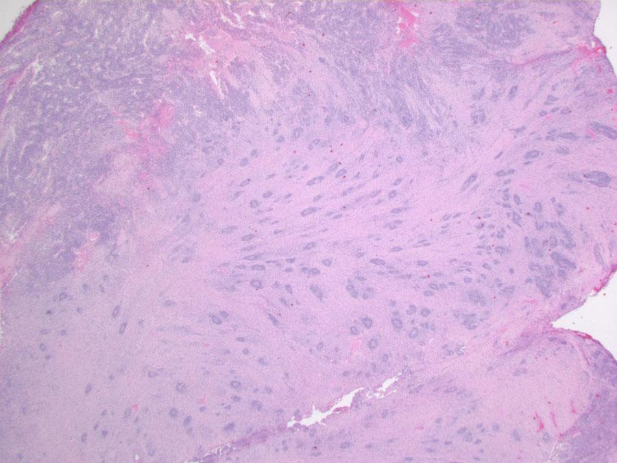 CNS PNET (embryonal tumors) Microscopic Pathology, Cont d.