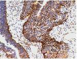 CNS PNET (embryonal tumors) Microscopic Pathology,