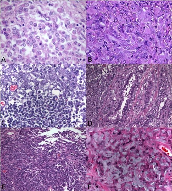 Atypical Teratoid / Rhabdoid Tumor Microscopic Pathology, Cont d.