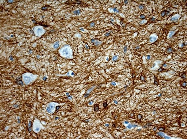 Considerations Glial Differentiation Glial derived cell types Astrocytes Oligodendrocytes Ependyma and Choroid Plexus More prominent epithelial features Histologically defined IHC Astrocytes (GFAP)