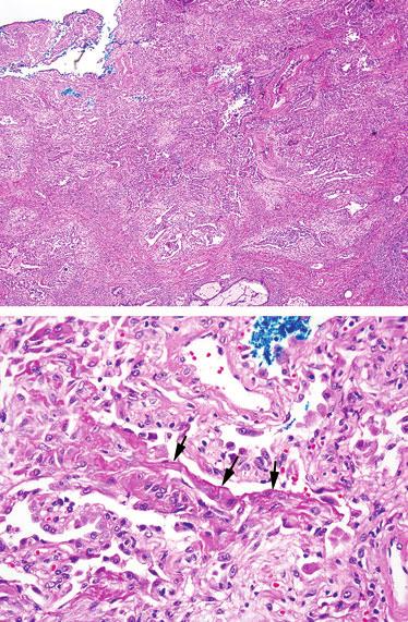 Hyperplastic epithelial cells are present overlying the fibroblast focus. B Honeycomb change is present in most surgical lung biopsy specimens and is another important diagnostic feature.