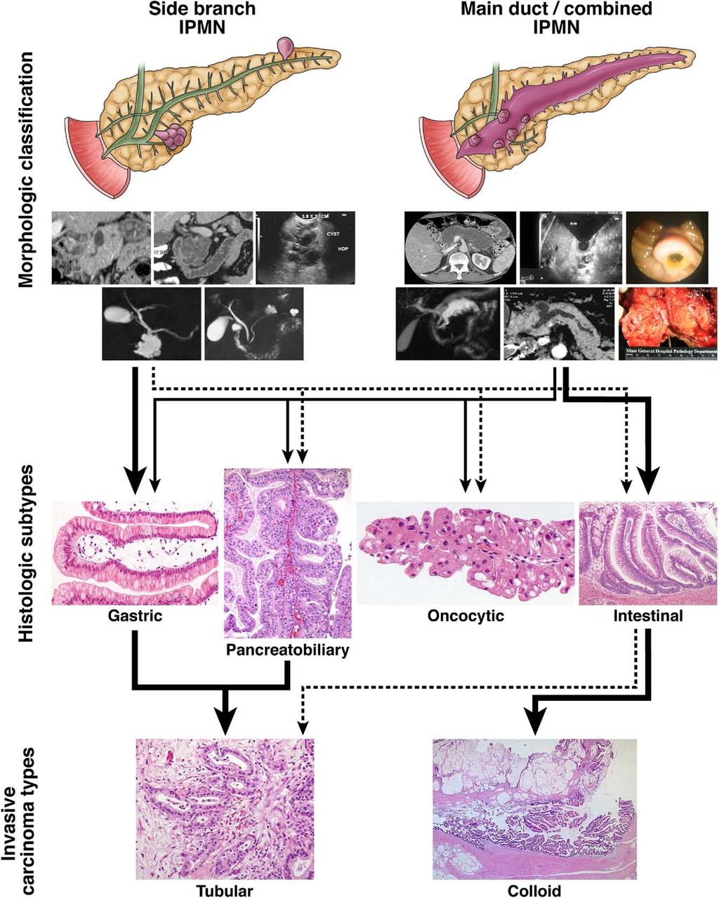 Figure 1. Morphologic and histologic subtypes of IPMNs, as well as the types of invasive cancer.
