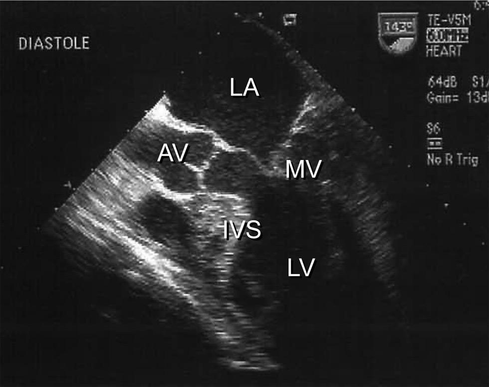 Myectomy and MVR for HOCM Fig. 1. Transesophageal echocardiogram (TEE) at diastolic (A) and systolic phase (B).