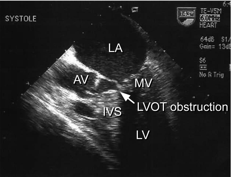 LV, left ventricle; LA, left atrium; MV, mitral valve; AV, aortic valve; LVOT, left ventricular outflow tract; IVS, interventricular septum.