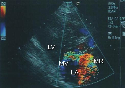 Since the papillary muscles revealed a marked hypertrophy through the aortotomy view, MVR and resection of the papillary muscles were performed in addition to septal myectomy in this case.