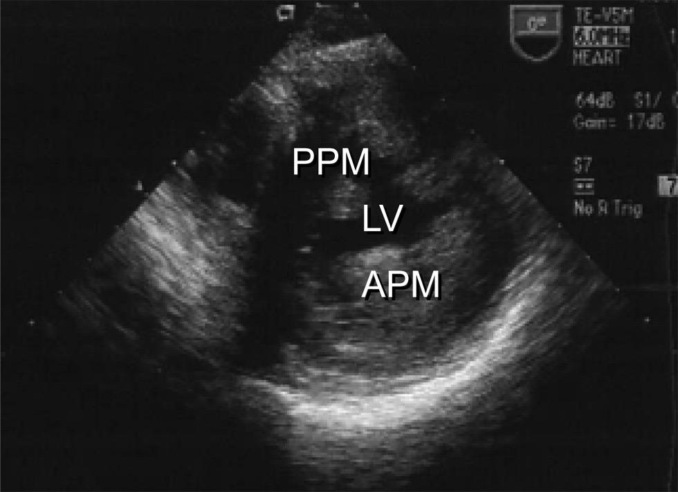 Echocardiogram at systolic phase showing grade 3 mitral regurgitation (MR) (A) and transesophageal echocardiogram (TEE) showing hypertrophic papillary muscles (B).