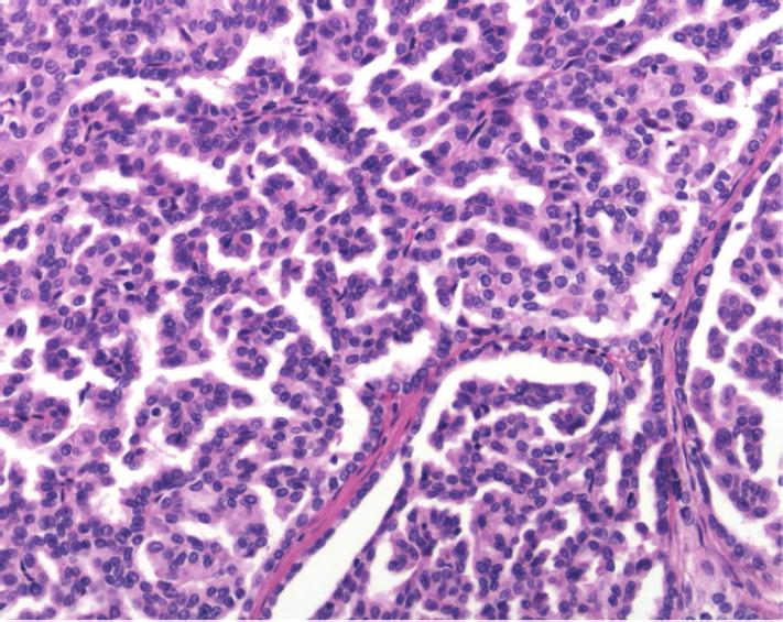 Case Reports in Urology 3 Figure 3: High power view of the lesion demonstrating papillary renalcellcarcinoma.
