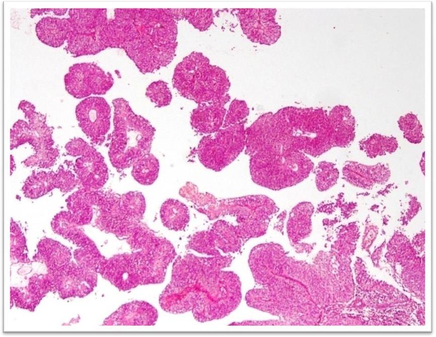 Mumtaz et al. International Archives of Medicine 2014, 7:36 Page 2 of 8 Figure 1 H & E stained sections of low grade urothelial carcinoma.