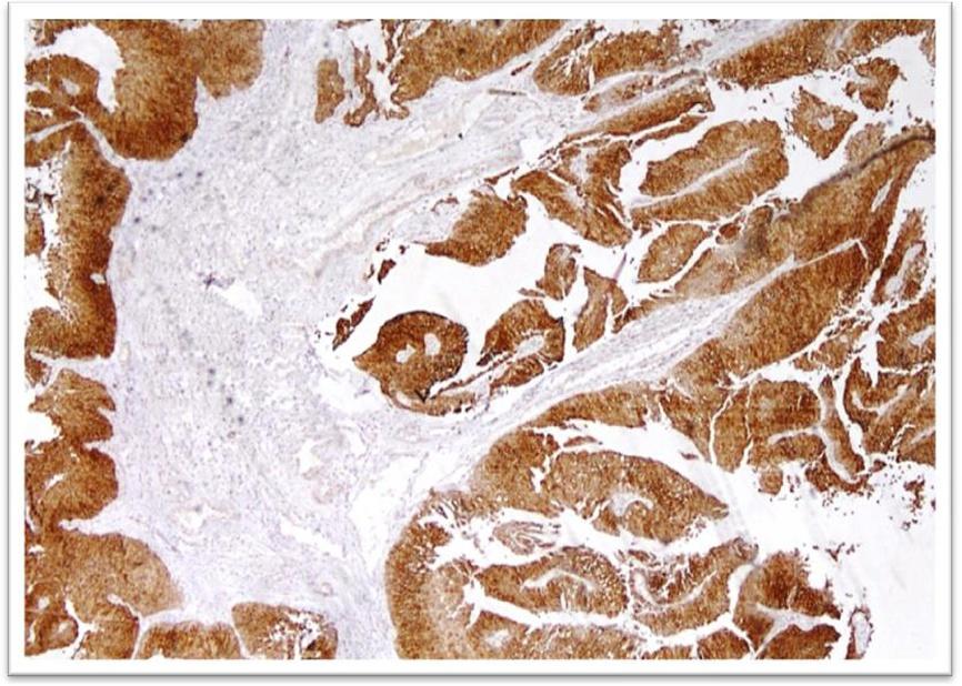 Mumtaz et al. International Archives of Medicine 2014, 7:36 Page 4 of 8 Figure 4 Cytokeratin 20 immunostaining in high grade urothelial carcinoma showing diffuse positive expression.