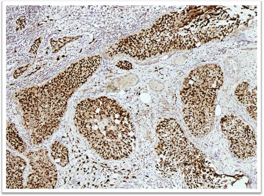 Mumtaz et al. International Archives of Medicine 2014, 7:36 Page 5 of 8 Figure 5 P53 immunostaining in high grade urothelial carcinoma.