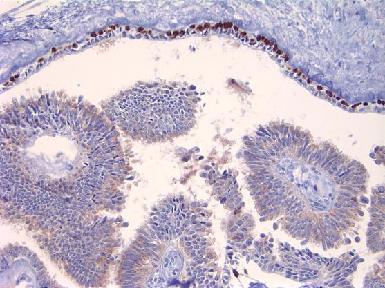 p63 Globoid Cells Myoepithelial Cells Papillary