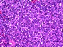 Papillary Carcinoma Considered to be a variant of DCIS Older women (mean age, early 70s) Mass, nipple