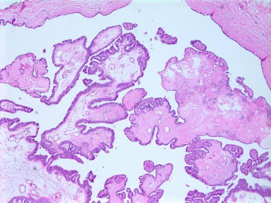 metaplasia Proliferation in adjacent ducts Epithelial and myoepithelial