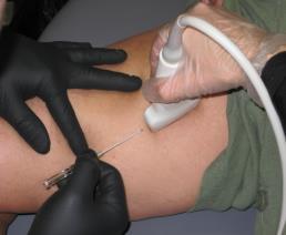 Sclerotherapy Ultrasound Guided Sclerotherapy Injection of a substance