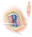 Echosclerotherapy Primary Rx of incompetent GSV and SSV Recurrence
