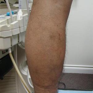 moderately sized varicosities along medial aspect of left leg and single on the right. Networks of telangiectasia with prominent reticular veins.