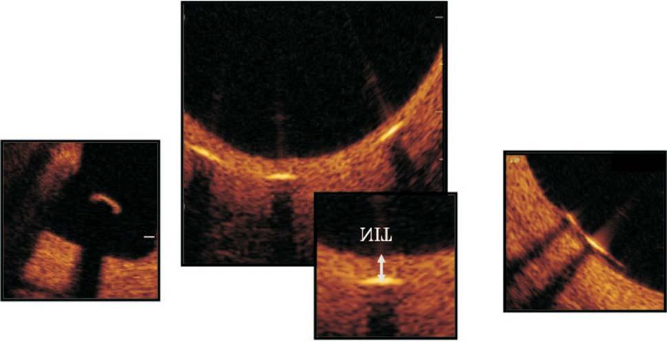 Yutaka Goryo et al. A B Figure 2. Stent strut condition by optical coherence tomography images. (A) Malapposed strut without coverage. (B) Covered struts and neointimal thickness (NIT).