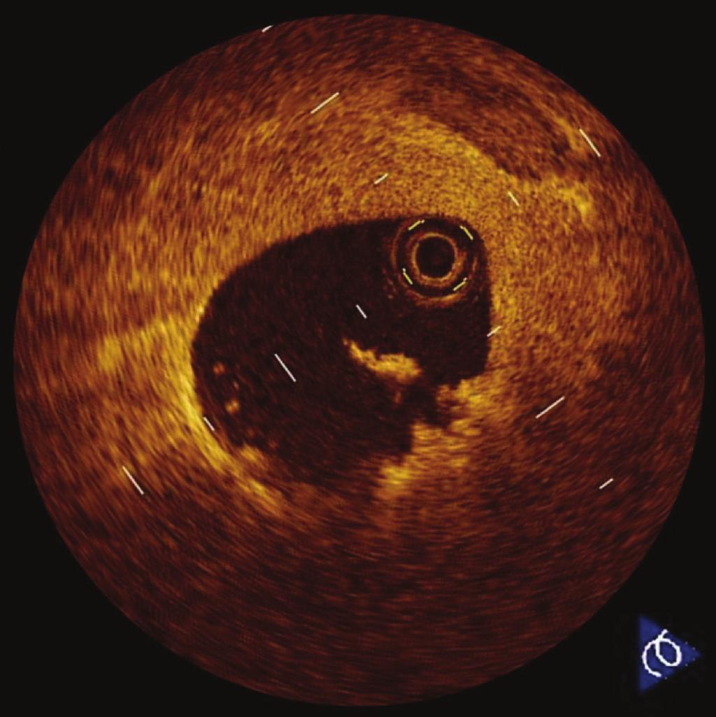 Figure 3: Intracoronary thrombus. Thrombus is defined as a protrusion inside the lumen of the artery with signal attenuation.