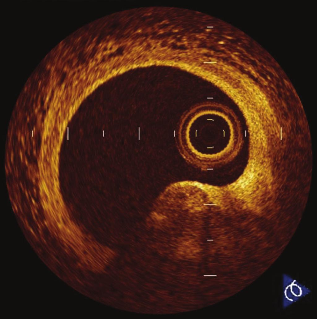 Cardiology Research and Practice 3 Figure 5: Calcified nodule. Calcified nodule is defined as a protrusion of a signal-poor or heterogeneous region with a sharply delineated border.