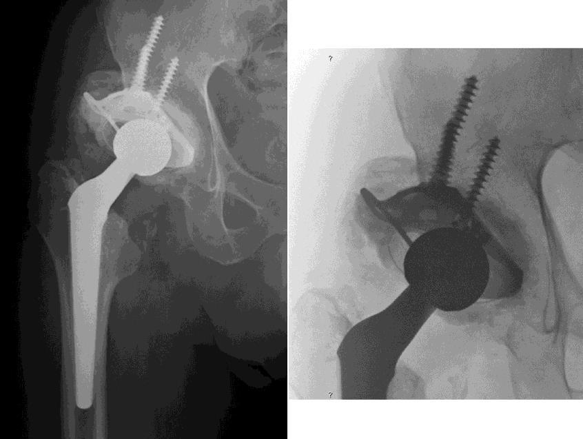An appropriate size supporting ring was chosen and secured with screws in order to achieve satisfactory mechanical fixation to the pelvis.