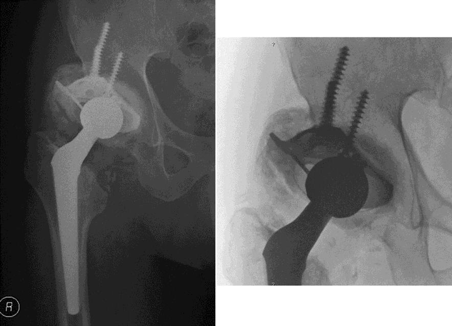 Figure 3. At follow-up period of 4-years, the THA radiograph showed stability of both components and no signs of bone graft resorption. Heterotopic ossifications with no functional impairment.