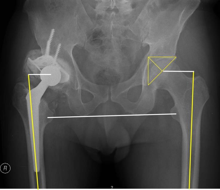 down to the depth of the original acetabular fossa. This condition led to incomplete bony coverage of the ring and suboptimal stability.