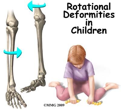 Introduction Rotational deformities of the legs and feet in children are often a cause of concern for parents. Most people think of the deformities as either toeing in or toeing out.
