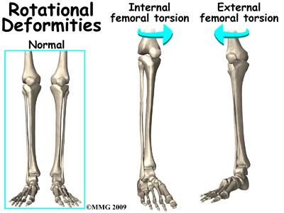 External femoral torsion is much less common. This is because the usual position in the uterus makes the femur rotate internally, not externally.