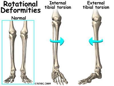 This means that the top of the foot lies against the shin of the same leg. This causes the foot to be in an externally (outward) rotated position.