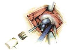 13 Fig. 14 The prosthesis is inserted by hand until resistance can be felt. The impactor (75.11.15-01) is used to ensure final seating of the Cone Prosthesis by hammer taps (Fig. 14).