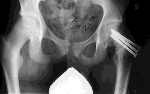 Stable SCFE (treatment) Osteotomy Severe chronic slip Proximal realignment Subcapital