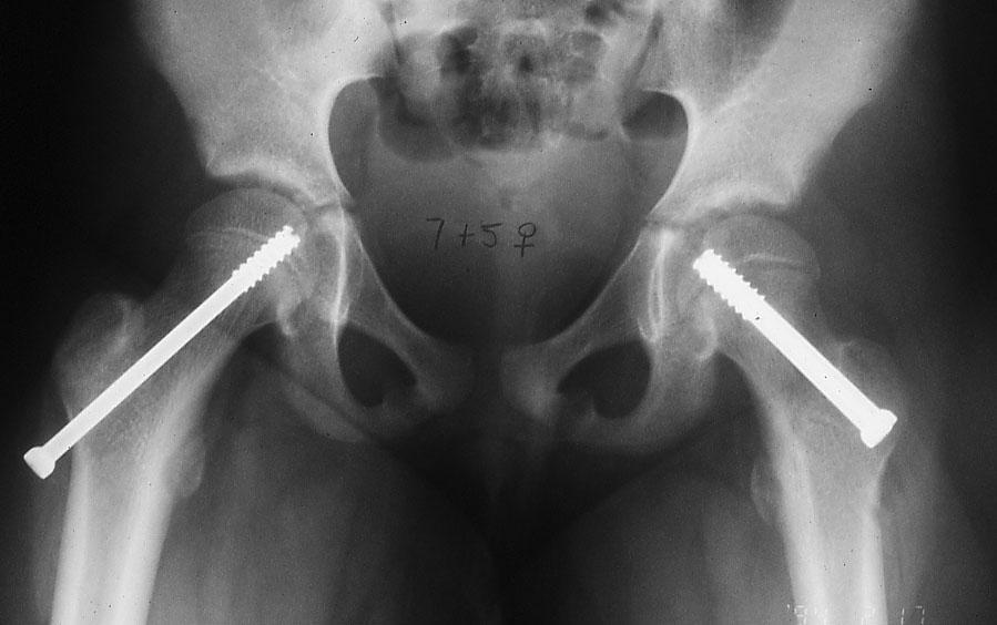 Prophylactic fixation of the contralateral hip Indications Younger patient
