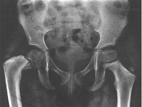 Developmental Coxa Vara Developmental coxa vara Not at birth, but in early childhood Progressive Primary ossification defect in the inferior femoral neck: