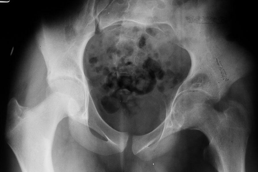 Idiopathic Chondrolysis of the Hip Idiopathic progressive destruction of articular cartilage from acetabulum & femoral head Joint space narrowing Stiffness