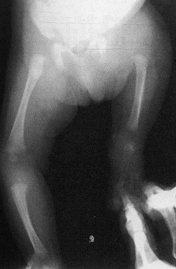 Proximal Femoral Focal Deficiency (PFFD) Spectrum of femoral defects Minor hypoplasia to complete agenesis Variable hip instability