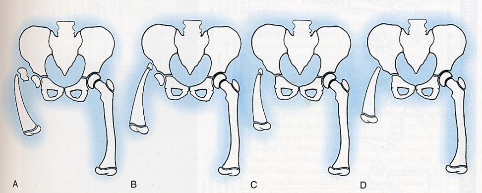 femur, intact hip II : short femur, coxa