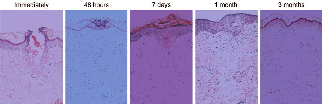 Histological progression of healing after fractional CO 2 laser injury. Re-epithelialization is complete within 48 hours.