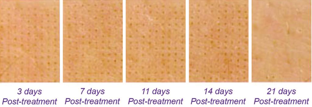Plastic and Reconstructive Surgery July 2009 Fig. 4. Example of progression of healing after fractional photothermolysis with 1550 nm, erbium:glass laser.