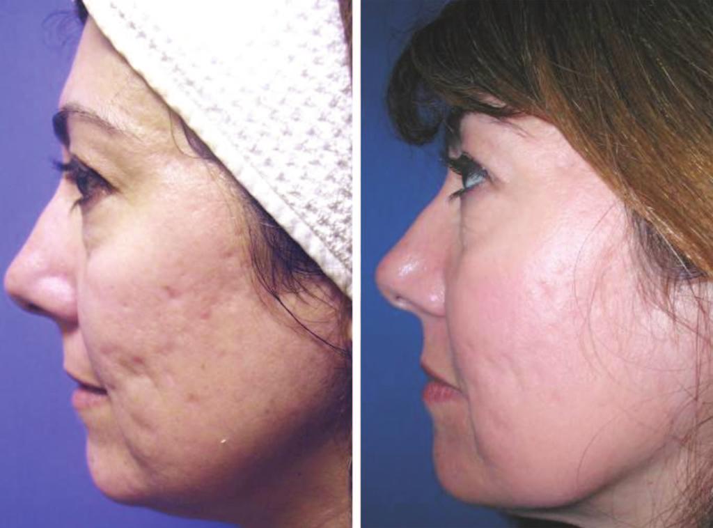 Plastic and Reconstructive Surgery July 2009 Fig. 7. (Above) Before and (below) after three treatments of patient with acne scarring treated with the 1550-nm erbium:glass laser.