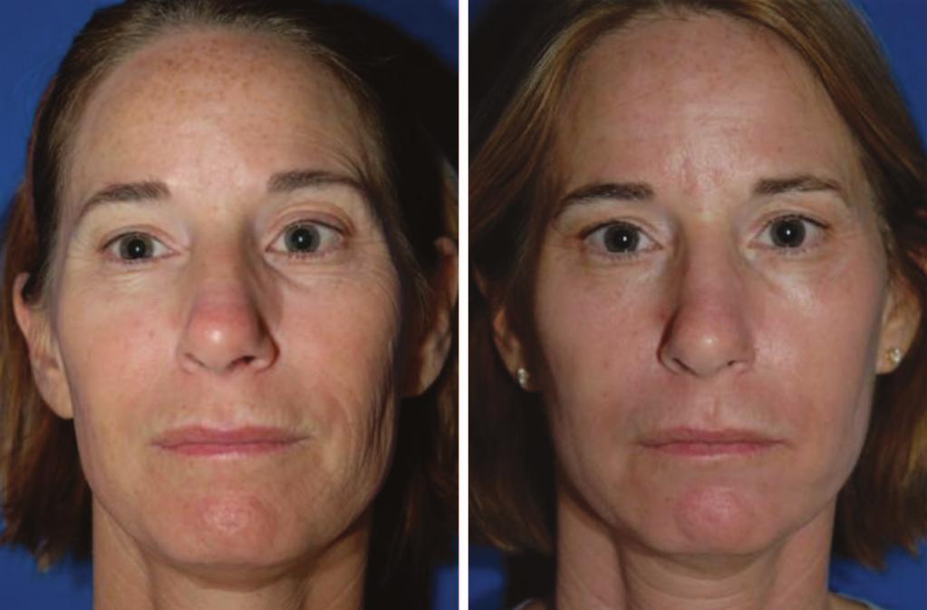 Volume 124, Number 1 Photothermolysis for Skin Rejuvenation Fig. 9. (Left) Before and (right) 1 month after fractional CO 2 (40 mj). Fig. 10.