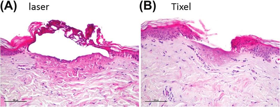 Journal of Cosmetic and Laser Therapy 3 Figure 4. Histopathology of (A) laser and (B) Tixel immediately after treatment of human skin.