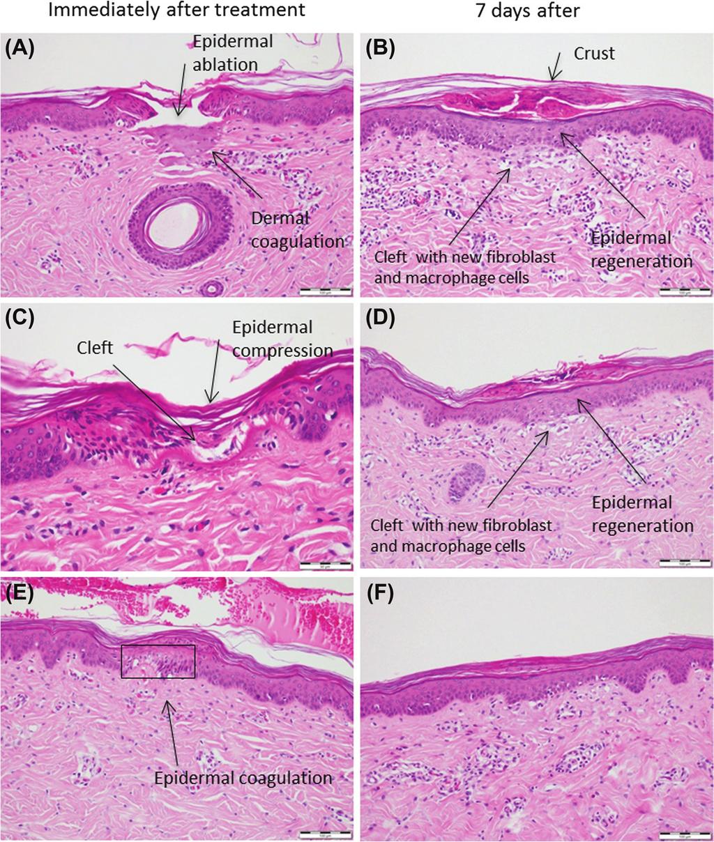 Journal of Cosmetic and Laser Therapy 5 Figure 7. Tixel histologies with S tip on in vivo porcine skin immediately after and 7 days after treatment.