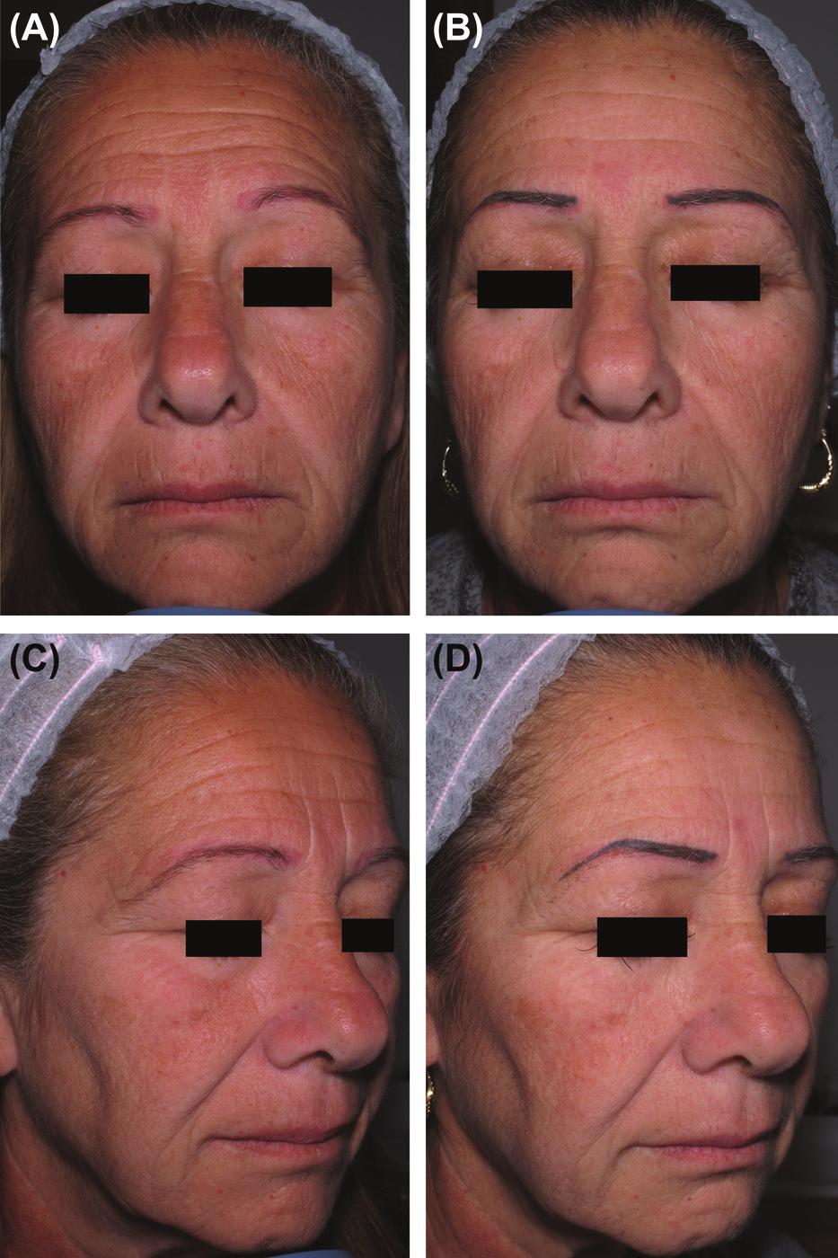 6 M. ELMAN ET AL. Figure 10. Periorbital treatment. (A,C) Before and (B,D) after 1 month from the 2nd treatment session with D tip, 14-ms single-pulse one pass.