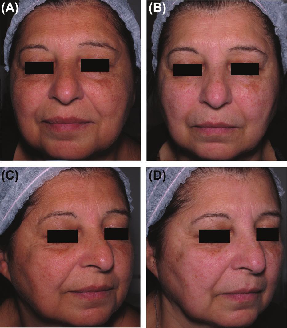 (A,C) Before and (B,D) after 4 months from the 3rd treatment session with D tip, 9 14-ms single-pulse one pass. Woman 58 years, phototype IV.
