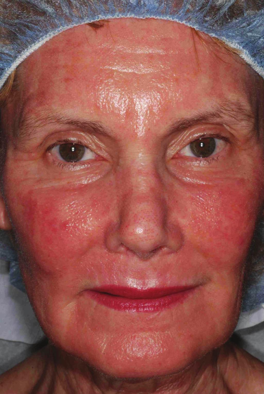 after an entire face treatment with 160 mj laser pulses: (a)