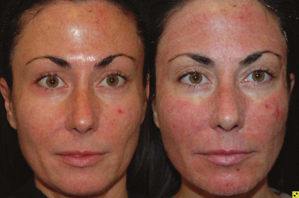 (a) Day-0 (b) 90 min (c) Day-1 (d) Day-7 Figure 6: Progression in skin appearance after an entire face treatment with
