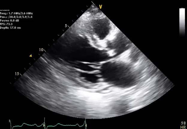 Case II 66 year old woman with history of previous MI presents with recurrent episodes of dyspnea with daily activities Onset of dyspnea 6 months ago, with a